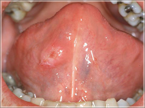 mouth polyp #9